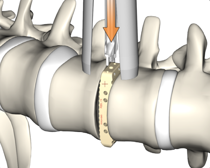 caja intervertebral