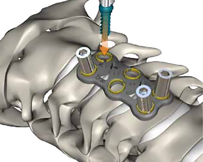 placa cervical